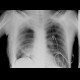 Residual cavity, lobectomy, supine radiograph: X-ray - Plain radiograph